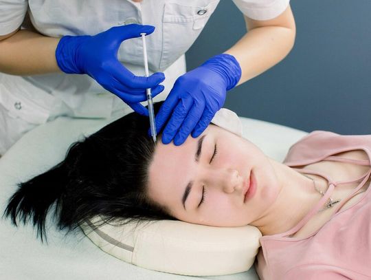 Przeszczep włosów - najważniejsze informacje