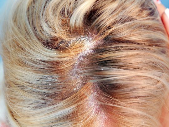 Wybór odpowiedniego szamponu - ulga dla skóry głowy dotkniętej łuszczycą